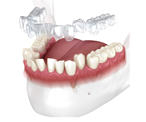 Invisalign