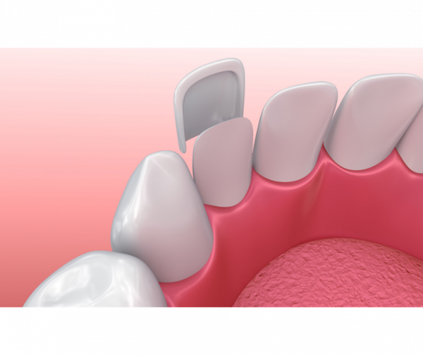 Veneers