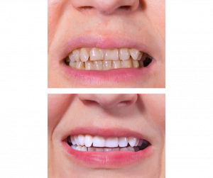 Teeth Whitening